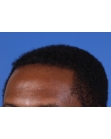 After Hair Transplant&nbsp;Front